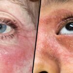 Living with Exzemen: Tips for Managing Your Skin Condition